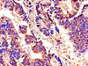 Immunohistochemistry of paraffin-embedded human colon cancer using CSB-PA857882LA01HU at dilution of 1:100