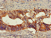 Immunohistochemistry of paraffin-embedded human colon cancer using CSB-PA858725LA01HU at dilution of 1:100