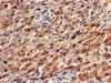 Immunohistochemistry of paraffin-embedded human liver cancer using CSB-PA858725LA01HU at dilution of 1:100