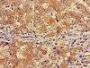 Immunohistochemistry of paraffin-embedded human liver cancer using CSB-PA861986LA01HU at dilution of 1:100
