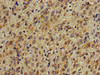Immunohistochemistry of paraffin-embedded human glioma using CSB-PA865102LA01HU at dilution of 1:100