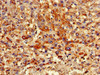 Immunohistochemistry of paraffin-embedded human liver cancer using CSB-PA868381LA01HU at dilution of 1:100 Immunohistochemistry of paraffin-embedded human liver cancer using CSB-PA868381LA01HU at dilution of 1:100