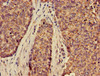 Immunohistochemistry of paraffin-embedded human ovarian cancer using CSB-PA873638LA01HU at dilution of 1:100 Immunohistochemistry of paraffin-embedded human ovarian cancer using CSB-PA873638LA01HU at dilution of 1:100