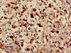 Immunohistochemistry of paraffin-embedded human melanoma using CSB-PA887172LA01HU at dilution of 1:100