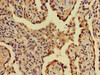 Immunohistochemistry of paraffin-embedded human lung cancer using CSB-PA001005LA01HU at dilution of 1:100