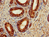 Immunohistochemistry of paraffin-embedded human prostate cancer using CSB-PA001134LA01HU at dilution of 1:100