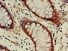 Immunohistochemistry of paraffin-embedded human colon cancer using CSB-PA001134LA01HU at dilution of 1:100
