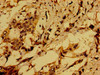 Immunohistochemistry of paraffin-embedded human pancreatic cancer using CSB-PA001246EA01HU at dilution of 1:100
