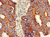 Immunohistochemistry of paraffin-embedded human colon cancer using CSB-PA002219LA01HU at dilution of 1:100