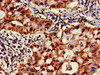 Immunohistochemistry of paraffin-embedded human lung cancer using CSB-PA004490EA01HU at dilution of 1:100