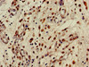 Immunohistochemistry of paraffin-embedded human lung cancer using CSB-PA005884LA01HU at dilution of 1:100