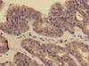 Immunohistochemistry of paraffin-embedded human endometrial cancer using CSB-PA005932EA01HU at dilution of 1:100