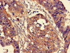 Immunohistochemistry of paraffin-embedded human colon cancer using CSB-PA006226LA01HU at dilution of 1:100