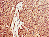 IHC image of CSB-PA007049LA01HU diluted at 1:600 and staining in paraffin-embedded human ovarian cancer performed on a Leica BondTM system. After dewaxing and hydration, antigen retrieval was mediated by high pressure in a citrate buffer (pH 6.0) . Section was blocked with 10% normal goat serum 30min at RT. Then primary antibody (1% BSA) was incubated at 4°C overnight. The primary is detected by a biotinylated secondary antibody and visualized using an HRP conjugated SP system.