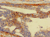 Immunohistochemistry of paraffin-embedded human colon cancer using CSB-PA00729A0Rb at dilution of 1:100