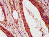 IHC image of CSB-PA011021LA01HU diluted at 1:600 and staining in paraffin-embedded human colon cancer performed on a Leica BondTM system. After dewaxing and hydration, antigen retrieval was mediated by high pressure in a citrate buffer (pH 6.0) . Section was blocked with 10% normal goat serum 30min at RT. Then primary antibody (1% BSA) was incubated at 4°C overnight. The primary is detected by a biotinylated secondary antibody and visualized using an HRP conjugated SP system.