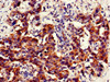 Immunohistochemistry of paraffin-embedded human bladder cancer using CSB-PA015422EA01HU at dilution of 1:100 Immunohistochemistry of paraffin-embedded human bladder cancer using CSB-PA015422EA01HU at dilution of 1:100