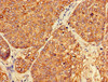 Immunohistochemistry of paraffin-embedded human ovarian cancer using CSB-PA017788LA01HU at dilution of 1:100