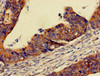 Immunohistochemistry of paraffin-embedded human colon cancer using CSB-PA017788LA01HU at dilution of 1:100