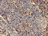 Immunohistochemistry of paraffin-embedded human cervical cancer using CSB-PA018206LA01HU at dilution of 1:100