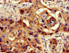 Immunohistochemistry of paraffin-embedded human cervical cancer using CSB-PA018504LA01HU at dilution of 1:100