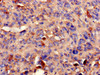 Immunohistochemistry of paraffin-embedded human melanoma using CSB-PA018564LA01HU at dilution of 1:100
