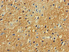 Immunohistochemistry of paraffin-embedded human glioma using CSB-PA018697LA01HU at dilution of 1:100