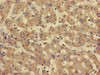 Immunohistochemistry of paraffin-embedded human liver cancer using CSB-PA021079LA01HU at dilution of 1:100