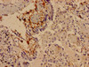 Immunocytochemistry analysis of human lung cancer using CSB-PA021774LA01HU at dilution of 1:100