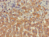 Immunohistochemistry of paraffin-embedded human liver cancer using CSB-PA022813EA01HU at dilution of 1:100
