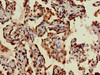 IHC image of CSB-PA023754LA01HU diluted at 1:400 and staining in paraffin-embedded human lung cancer performed on a Leica BondTM system. After dewaxing and hydration, antigen retrieval was mediated by high pressure in a citrate buffer (pH 6.0) . Section was blocked with 10% normal goat serum 30min at RT. Then primary antibody (1% BSA) was incubated at 4°C overnight. The primary is detected by a biotinylated secondary antibody and visualized using an HRP conjugated SP system.