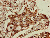 Immunohistochemistry of paraffin-embedded human pancreatic cancer using CSB-PA608122LA01HU at dilution of 1:100