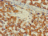 Immunohistochemistry of paraffin-embedded human liver cancer using CSB-PA610840LA01HU at dilution of 1:100