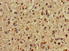 Immunohistochemistry of paraffin-embedded human glioma using CSB-PA623101LA01HU at dilution of 1:100