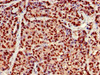 Immunohistochemistry of paraffin-embedded human ovarian cancer using CSB-PA705509LA01HU at dilution of 1:100