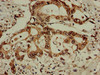 Immunohistochemistry of paraffin-embedded human pancreatic cancer using CSB-PA745333LA01HU at dilution of 1:100