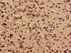 Immunocytochemistry analysis of human glioma using CSB-PA822197LA01HU at dilution of 1:100