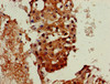 Immunohistochemistry of paraffin-embedded human breast cancer using CSB-PA859934LA01HU at dilution of 1:100