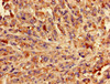 Immunohistochemistry of paraffin-embedded human melanoma using CSB-PA872478LA01HU at dilution of 1:100