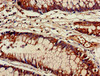 Immunohistochemistry of paraffin-embedded human colon cancer using CSB-PA887999EA01HU at dilution of 1:100