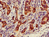 Immunohistochemistry of paraffin-embedded human pancreatic cancer using CSB-PA016039LA01HU at dilution of 1:100