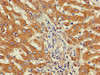 Immunohistochemistry of paraffin-embedded human liver cancer using CSB-PA851968LA01HU at dilution of 1:100