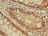 Immunohistochemistry of paraffin-embedded human colon cancer using CSB-PA865087LA01HU at dilution of 1:100