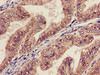 Immunohistochemistry of paraffin-embedded human endometrial cancer using CSB-PA001453LA01HU at dilution of 1:100