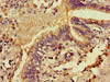 Immunohistochemistry of paraffin-embedded human lung cancer using CSB-PA818265LA01HU at dilution of 1:100