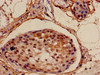 Immunohistochemistry of paraffin-embedded human breast cancer using CSB-PA878874LA01HU at dilution of 1:100