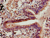 Immunohistochemistry of paraffin-embedded human lung cancer using CSB-PA005507LA01HU at dilution of 1:100 Immunohistochemistry of paraffin-embedded human lung cancer using CSB-PA005507LA01HU at dilution of 1:100