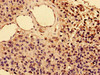 Immunohistochemistry of paraffin-embedded human glioma using CSB-PA011649LA01HU at dilution of 1:100