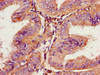 Immunohistochemistry of paraffin-embedded human endometrial cancer using CSB-PA018749YA01HU at dilution of 1:100 Immunohistochemistry of paraffin-embedded human endometrial cancer using CSB-PA018749YA01HU at dilution of 1:100