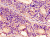 Immunohistochemistry of paraffin-embedded human colon cancer using CSB-PA018749YA01HU at dilution of 1:100 Immunohistochemistry of paraffin-embedded human colon cancer using CSB-PA018749YA01HU at dilution of 1:100